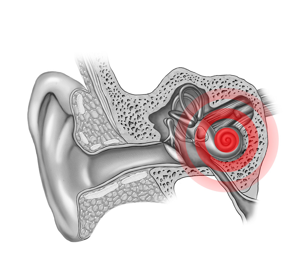 Ipoacusia Neurosensoriale